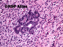 12. Wilms tumor, nephroblastoma, stromal type, 20x