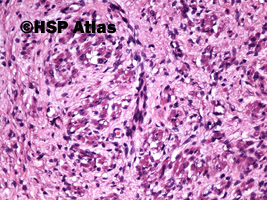 13. Guz Wilmsa (Wilms tumor, nephroblastoma, stromal type), 20x