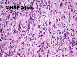 14. Guz Wilmsa (Wilms tumor, nephroblastoma, stromal type), 20x