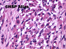 15. Guz Wilmsa (Wilms tumor, nephroblastoma, stromal type), 40x