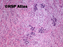 2. Wilms tumor, nephroblastoma, stromal type, 4x
