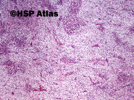 3. Guz Wilmsa (Wilms tumor, nephroblastoma, stromal type), 4x