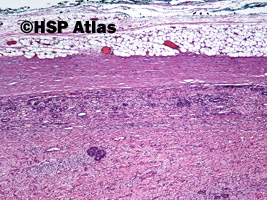 5. Wilms tumor, nephroblastoma, stromal type, 4x