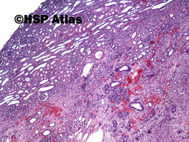 6. Wilms tumor, nephroblastoma, stromal type, 4x