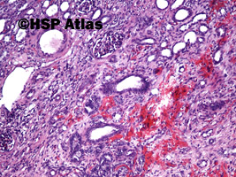 7. Guz Wilmsa (Wilms tumor, nephroblastoma, stromal type), 10x