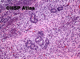 8. Guz Wilmsa (Wilms tumor, nephroblastoma, stromal type), 10x