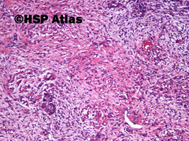 9. Guz Wilmsa (Wilms tumor, nephroblastoma, stromal type), 10x